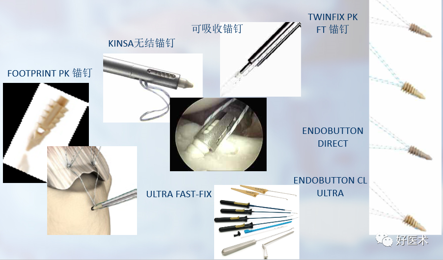 关节镜配套哪些关节镜技术速成诀窍_https://www.jmylbn.com_新闻资讯_第32张