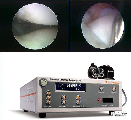 关节镜配套哪些关节镜技术速成诀窍_https://www.jmylbn.com_新闻资讯_第4张