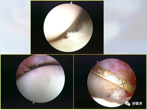 关节镜配套哪些关节镜技术速成诀窍_https://www.jmylbn.com_新闻资讯_第39张
