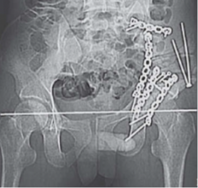 风险高？一文总结陈旧性骨盆骨折治疗的难点与要点