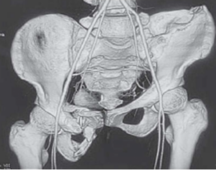 风险高？一文总结陈旧性骨盆骨折治疗的难点与要点