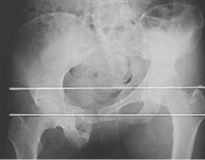 风险高？一文总结陈旧性骨盆骨折治疗的难点与要点