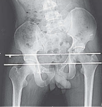 风险高？一文总结陈旧性骨盆骨折治疗的难点与要点