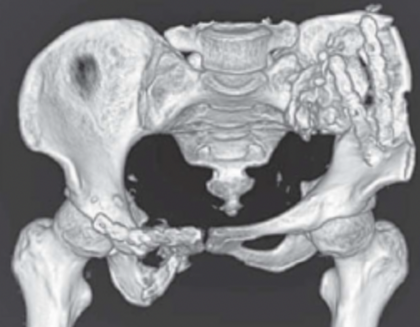 风险高？一文总结陈旧性骨盆骨折治疗的难点与要点