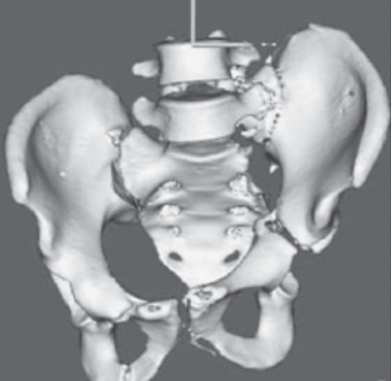 风险高？一文总结陈旧性骨盆骨折治疗的难点与要点