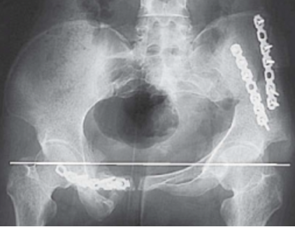 风险高？一文总结陈旧性骨盆骨折治疗的难点与要点