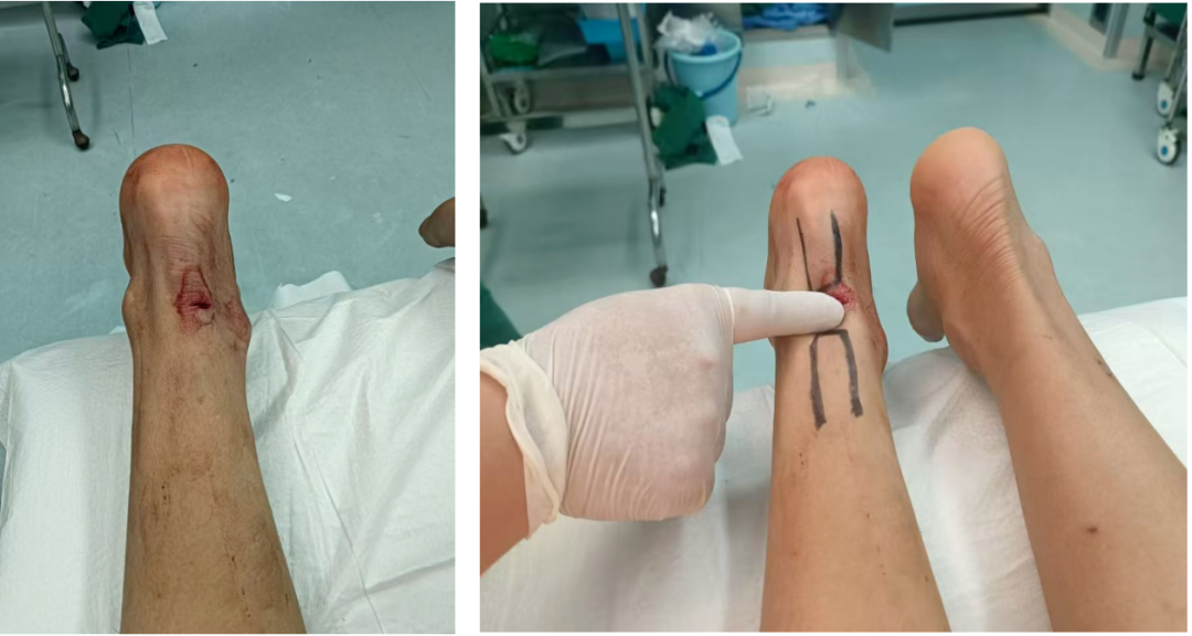 跟腱断裂的微创治疗，你都掌握了吗？