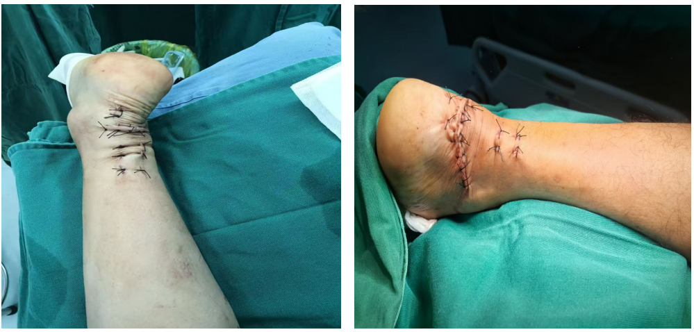 跟腱断裂的微创治疗，你都掌握了吗？