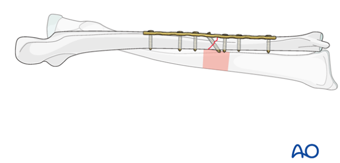 AO标准手术︱成人孟氏骨折脱位：复位顺序、固定技巧及术后护理要点详解
