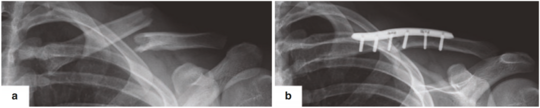 基于Robinson分类法，详解锁骨骨折的分型与治疗