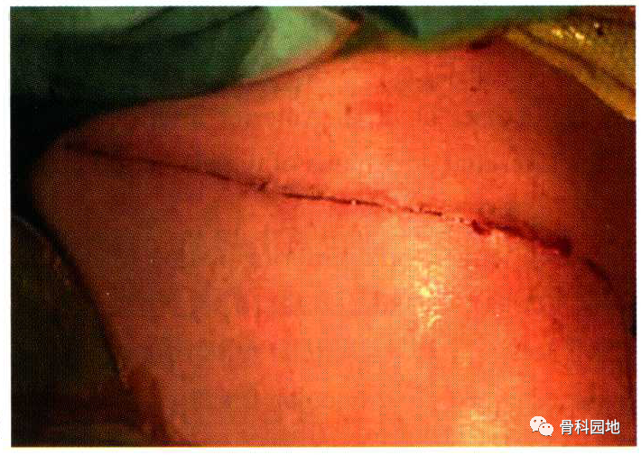 不得不知的锁骨骨折切开复位钢板螺钉内固定经验技巧