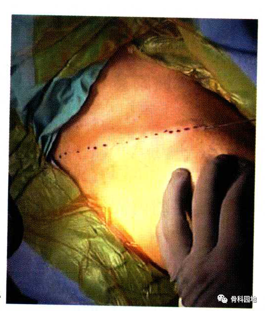 不得不知的锁骨骨折切开复位钢板螺钉内固定经验技巧