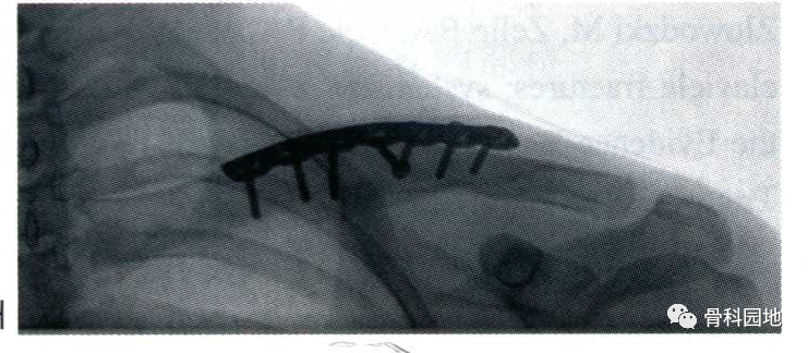 不得不知的锁骨骨折切开复位钢板螺钉内固定经验技巧