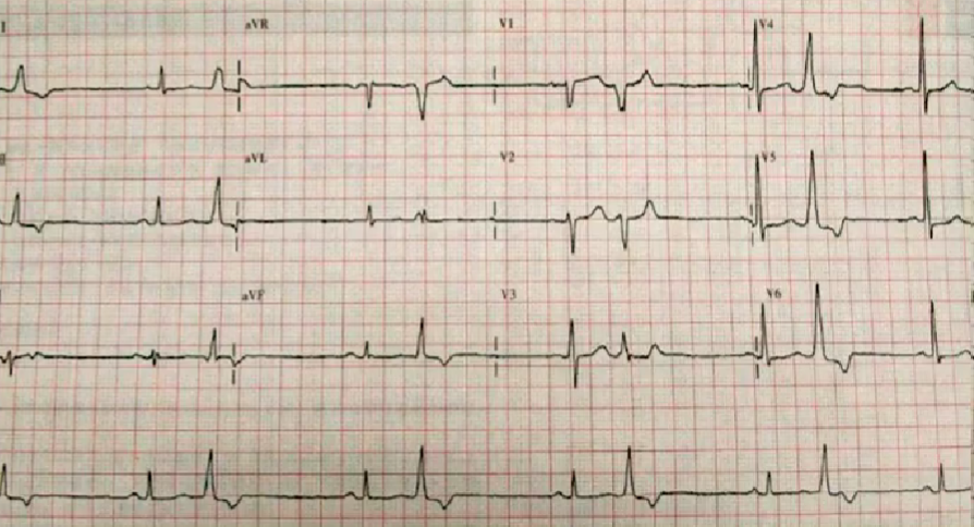 心律解码丨室性心律失常药物选用难？看完这份处理策略就好了！