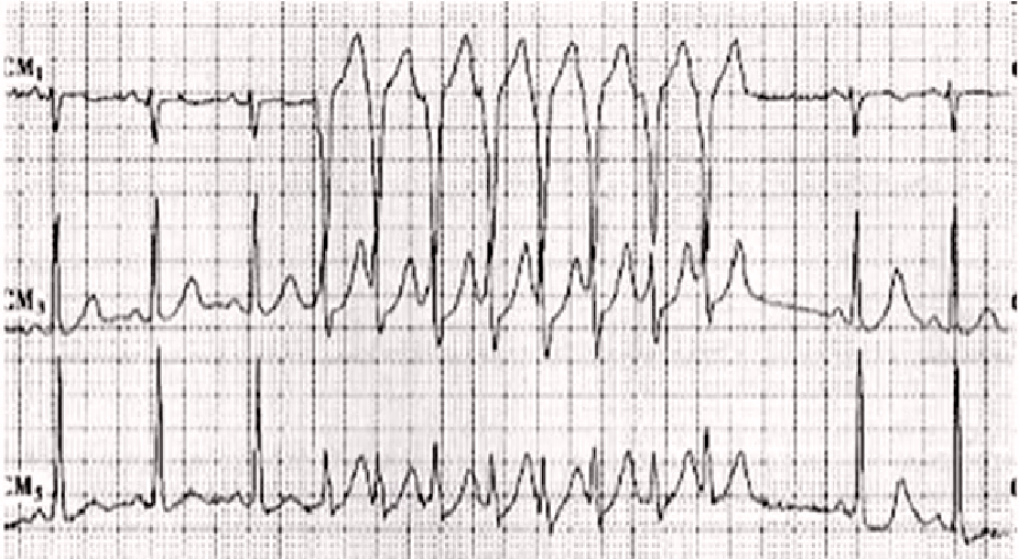 心律解码丨室性心律失常药物选用难？看完这份处理策略就好了！