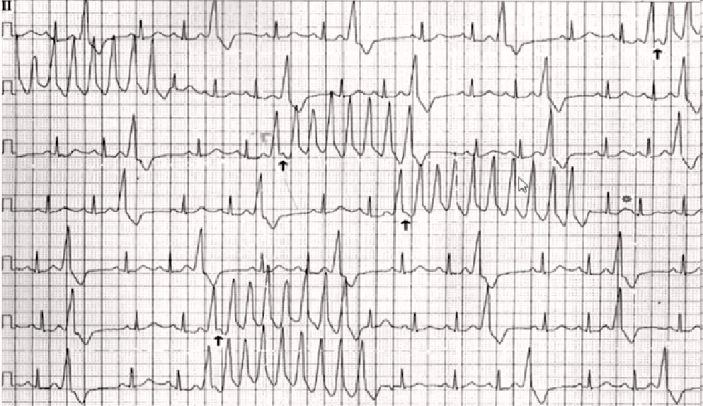 心律解码丨室性心律失常药物选用难？看完这份处理策略就好了！