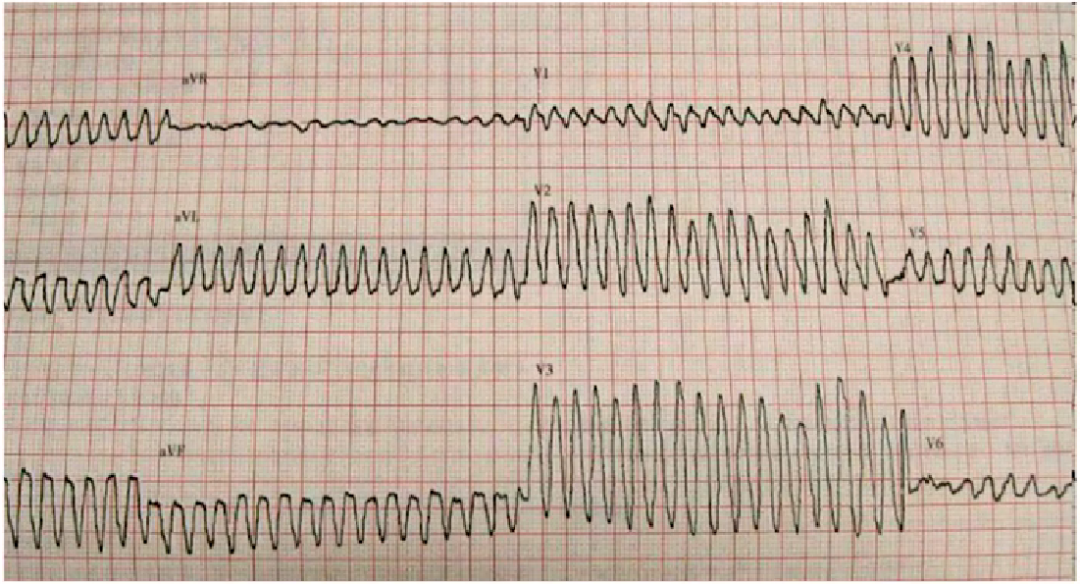 心律解码丨室性心律失常药物选用难？看完这份处理策略就好了！