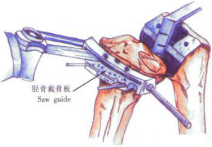 ​给你整理好了！人工膝关节置换手术步骤全解