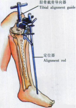 ​给你整理好了！人工膝关节置换手术步骤全解