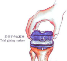 ​给你整理好了！人工膝关节置换手术步骤全解