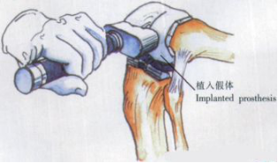 ​给你整理好了！人工膝关节置换手术步骤全解