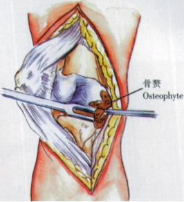 ​给你整理好了！人工膝关节置换手术步骤全解