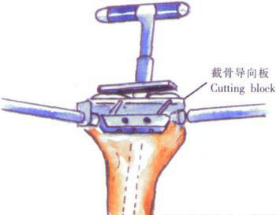 ​给你整理好了！人工膝关节置换手术步骤全解