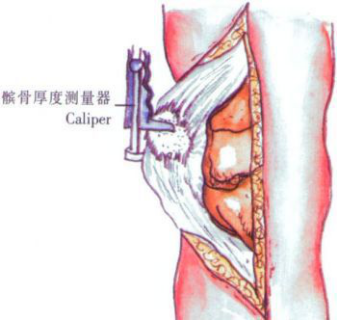 ​给你整理好了！人工膝关节置换手术步骤全解