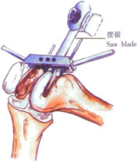 ​给你整理好了！人工膝关节置换手术步骤全解