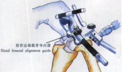 ​给你整理好了！人工膝关节置换手术步骤全解