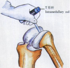 ​给你整理好了！人工膝关节置换手术步骤全解
