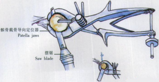 ​给你整理好了！人工膝关节置换手术步骤全解