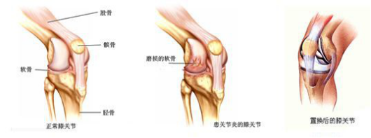 ​给你整理好了！人工膝关节置换手术步骤全解