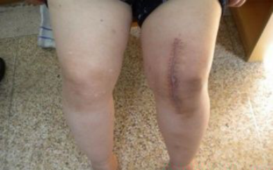 ​给你整理好了！人工膝关节置换手术步骤全解