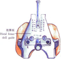 ​给你整理好了！人工膝关节置换手术步骤全解