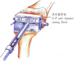 ​给你整理好了！人工膝关节置换手术步骤全解