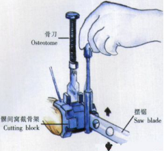 ​给你整理好了！人工膝关节置换手术步骤全解