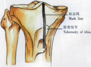 ​给你整理好了！人工膝关节置换手术步骤全解