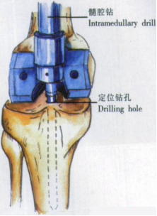 ​给你整理好了！人工膝关节置换手术步骤全解