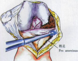 ​给你整理好了！人工膝关节置换手术步骤全解