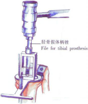 ​给你整理好了！人工膝关节置换手术步骤全解