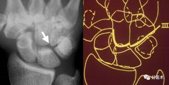 品读 腕关节x线高清解剖及腕骨脱位典型病例 影像诊断轻松学 微信公众号文章阅读 Wemp