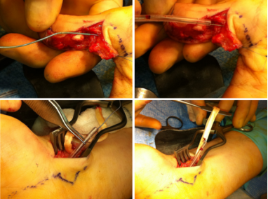 手部II区屈肌腱断裂回缩后难以取出，该如何处理？