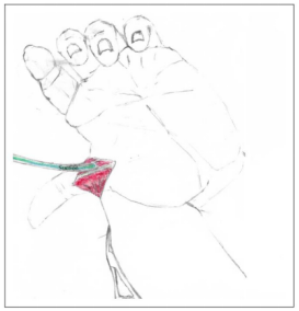 手部II区屈肌腱断裂回缩后难以取出，该如何处理？