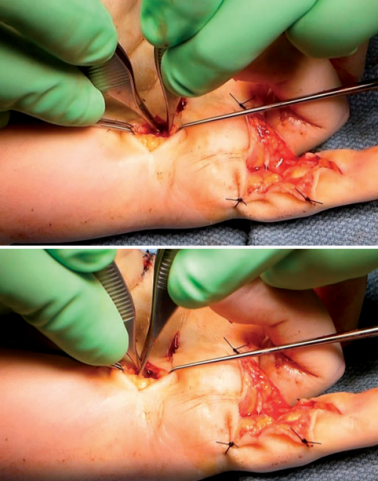 手部II区屈肌腱断裂回缩后难以取出，该如何处理？