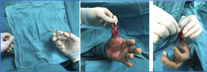 手部II区屈肌腱断裂回缩后难以取出，该如何处理？