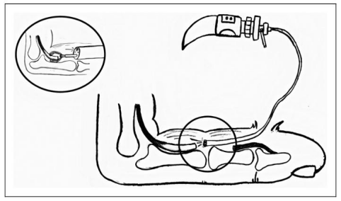 手部II区屈肌腱断裂回缩后难以取出，该如何处理？