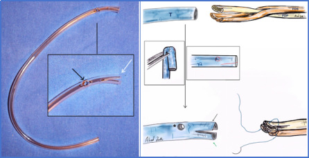 手部II区屈肌腱断裂回缩后难以取出，该如何处理？
