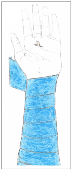 手部II区屈肌腱断裂回缩后难以取出，该如何处理？