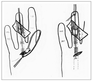 手部II区屈肌腱断裂回缩后难以取出，该如何处理？